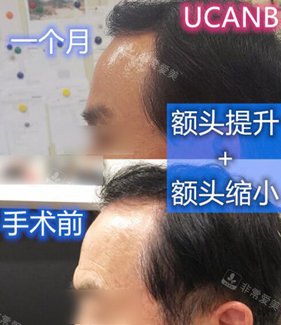 韓國UcanB男士額頭提升+縮小對(duì)比 韓國UcanB男士額頭提升+縮小對(duì)比