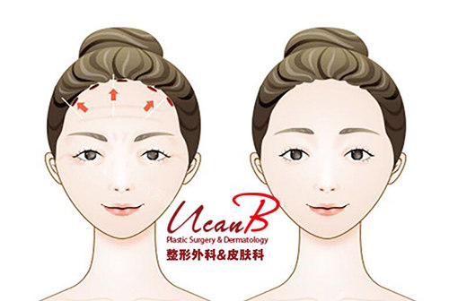 韓國UcanB整形外科額頭縮小卡通 韓國UcanB整形外科額頭縮小卡通