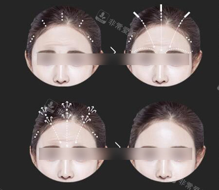 額頭縮小手術(shù)過程展示圖 額頭縮小手術(shù)過程展示圖