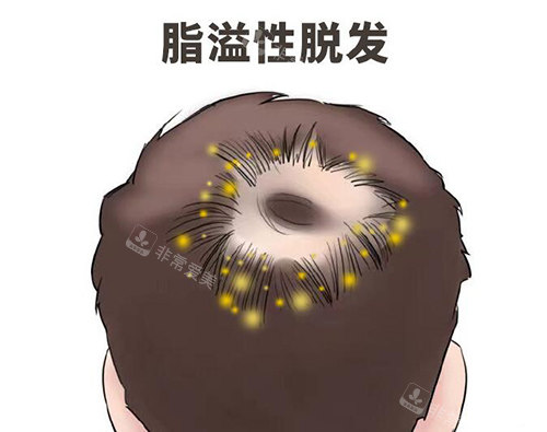 脂溢性脫發(fā)治療卡通照片 脂溢性脫發(fā)治療卡通照片
