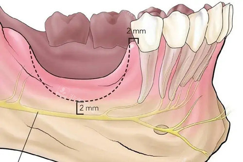 牙骨吸收展示图