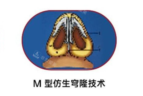 谭立文医生做鼻子好吗