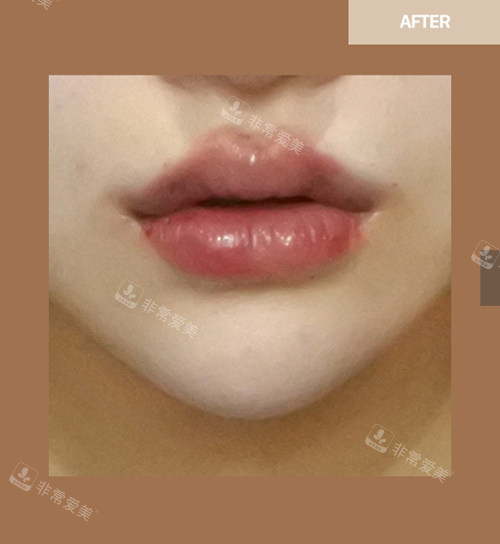 韩国Newstar Clinic整形医院唇部整形对比照
