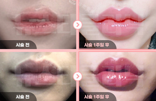 韩国Newstar Clinic整形医院唇部整形对比