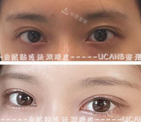 韓國(guó)UcanB整形外科眼型矯正照片 韓國(guó)UcanB整形外科眼型矯正照片