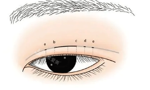 眼部整形方法图
