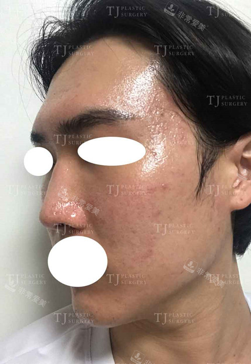 韩国TJ整形医院脂肪填充隆鼻手术前图片
