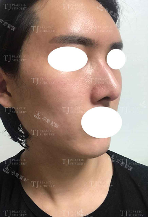 韩国TJ真人脂肪填充隆鼻手术后图片
