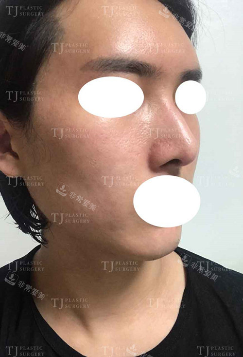韓國TJ真人脂肪填充隆鼻手術(shù)后圖片 韓國TJ真人脂肪填充隆鼻手術(shù)后圖片