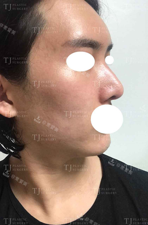 韩国TJ脂肪填充隆鼻疗效图