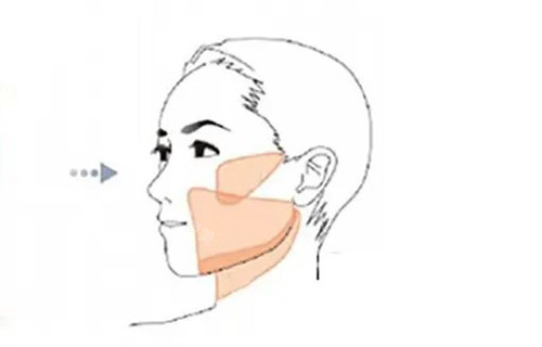 在韩国365mc医院面部吸脂大脸变v脸，亲测技术值得认可！