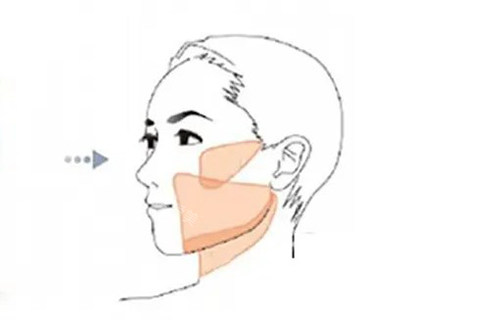 面部吸脂部位