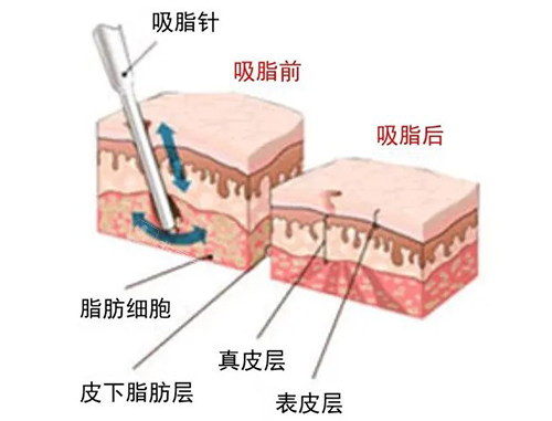 吸脂手术原理