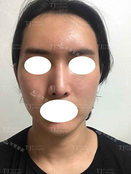 韓國TJ脂肪填充隆鼻正面圖 韓國TJ脂肪填充隆鼻正面圖