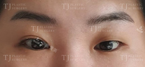 韩国TJ整形真人自然黏连双眼皮术前图片