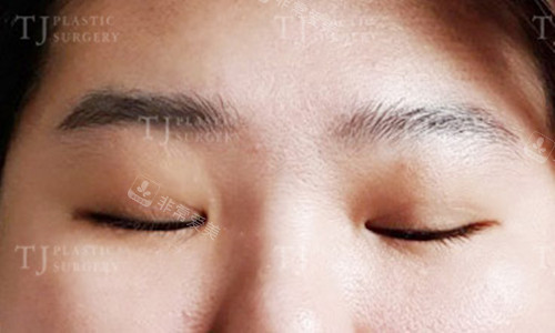 自然黏連雙眼皮術(shù)后閉眼圖片 自然黏連雙眼皮術(shù)后閉眼圖片