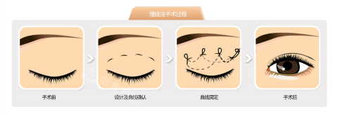 韓國貝緹萊茵整形醫(yī)院埋線雙眼皮過程 韓國貝緹萊茵整形醫(yī)院埋線雙眼皮過程
