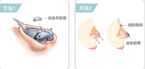 韩国贝缇莱茵整形医院鼻部整形手术方法