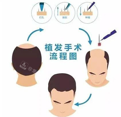 植發(fā)手術(shù)流程圖卡通 植發(fā)手術(shù)流程圖卡通