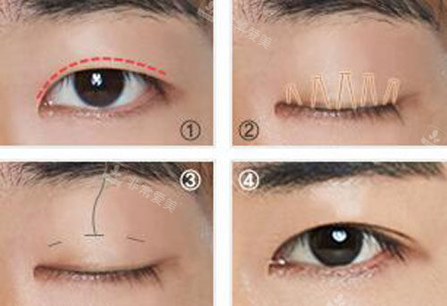 韩国秀美颜男士眼鼻整形手术特点公布，风格特点大不同！