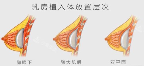 隆胸假体植入位置示意图