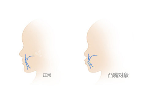 正常脸型与凸嘴脸型的区别