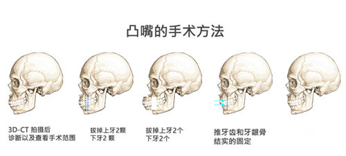 韩国德莱茵整形凸嘴手术步骤图