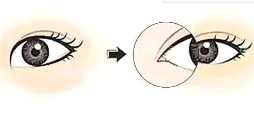 韩国芙莱思整形医院开眼角手术图