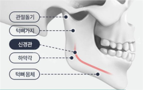 揭秘：韩国欧佩拉面部轮廓整形7、8、10件套都包括哪些项目