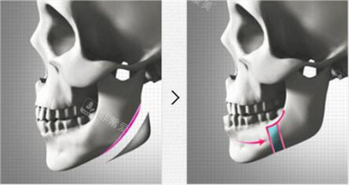 下颌角手术示意图