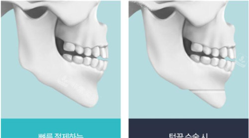 下巴整形示意图