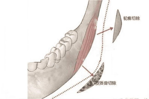下頜角皮質(zhì)骨截取示意圖