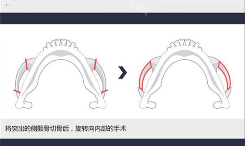 侧颧骨整形示意图