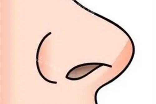 鼻综合手术示意图