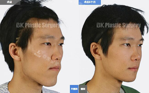韩国BK整形医院下颚前突矫正手术