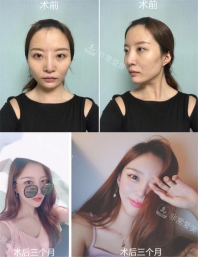 韓國必嫵輪廓三件套整形前后對比照片