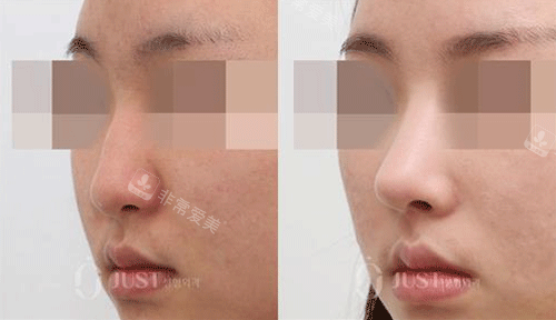 韩国just整形外科隆鼻图片，初鼻和鼻修复竟然做的都好！