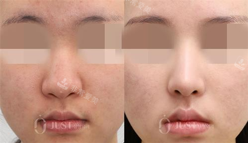 韩国just整形外科隆鼻图片，初鼻和鼻修复竟然做的都好！