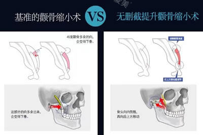 韩国菲斯莱茵医院无删除颧骨缩小提升术图