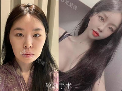 韓國菲斯萊茵整形醫(yī)院輪廓前后圖 韓國菲斯萊茵整形醫(yī)院輪廓前后圖