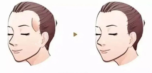 韩国特秀恩碧整形外科面部轮廓填充介绍，看过再做选择！