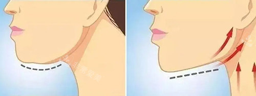 玻尿酸注射后下頜線對(duì)比