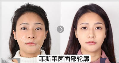 菲斯萊茵面部輪廓手術真人實例