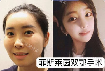 菲斯萊茵雙顎手術真人實例