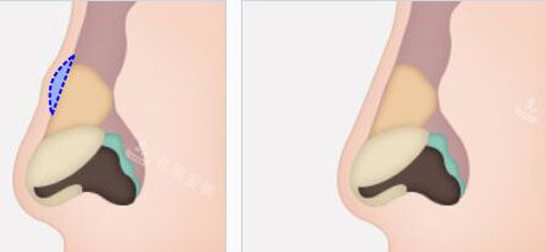 韩国秀美颜整形外科隆鼻细节示意图