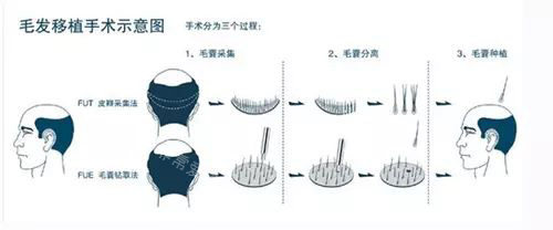 毛发移植手术过程示意图