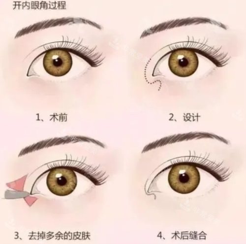 开眼角过程示意图 开眼角过程示意图