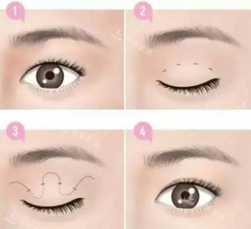 双眼皮手术动画图 双眼皮手术动画图