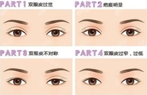 双眼皮需要修复的各种问题 双眼皮需要修复的各种问题