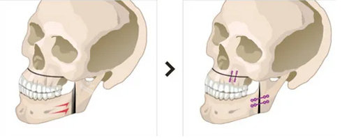 双颚整形手术示意图
